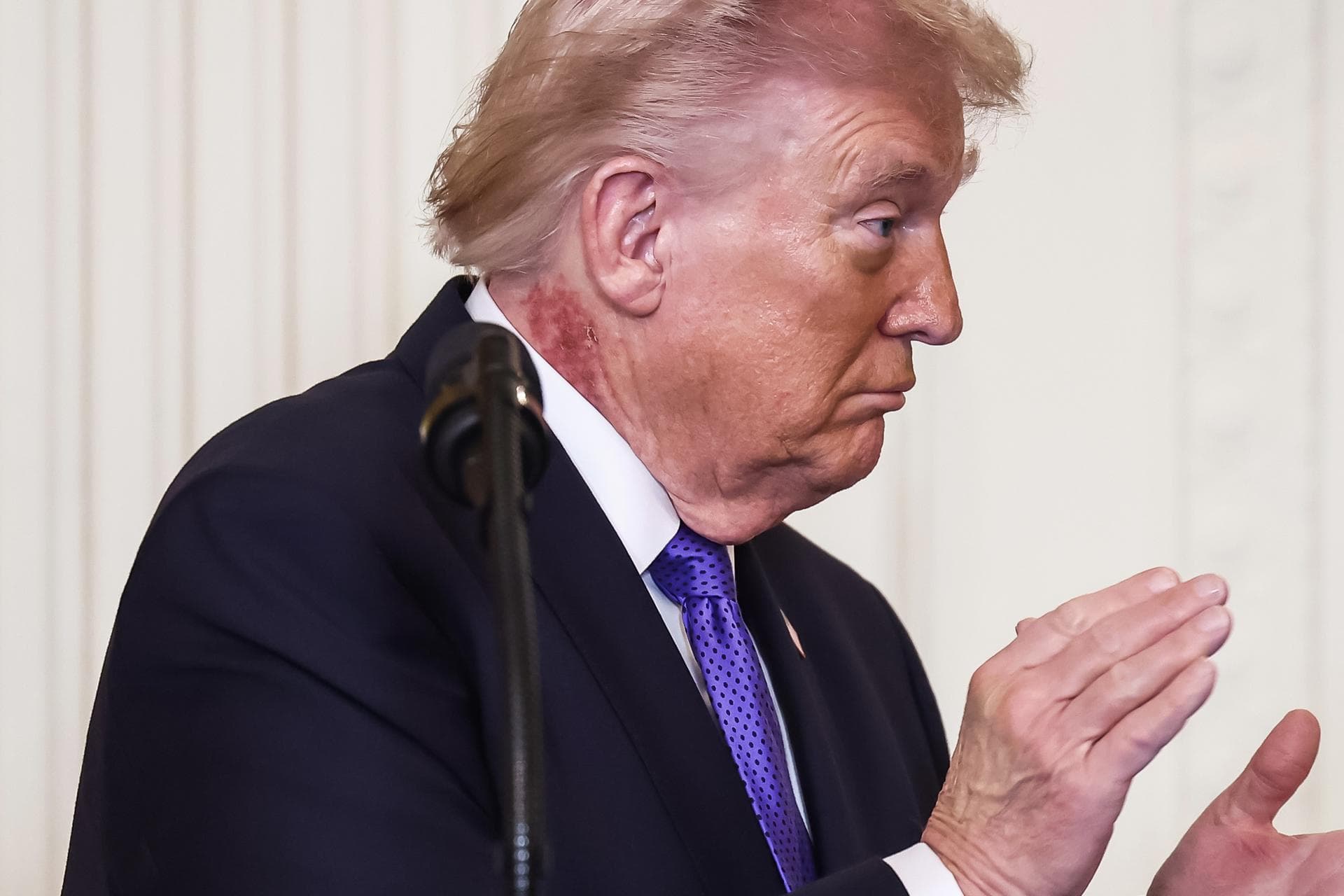Trump luce un sarpullido en el cuello